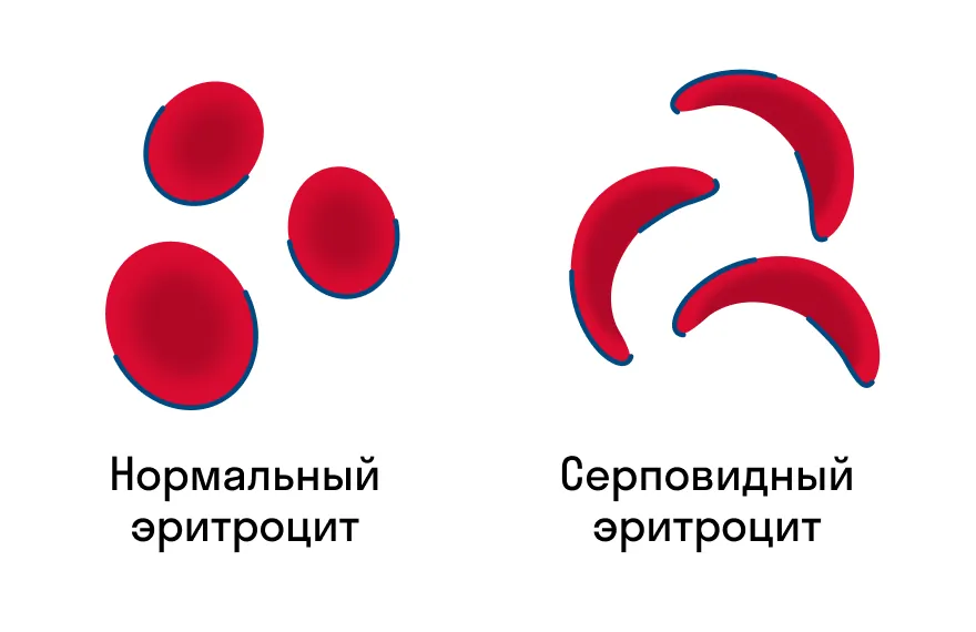 Последствия серповидноклеточной анемии